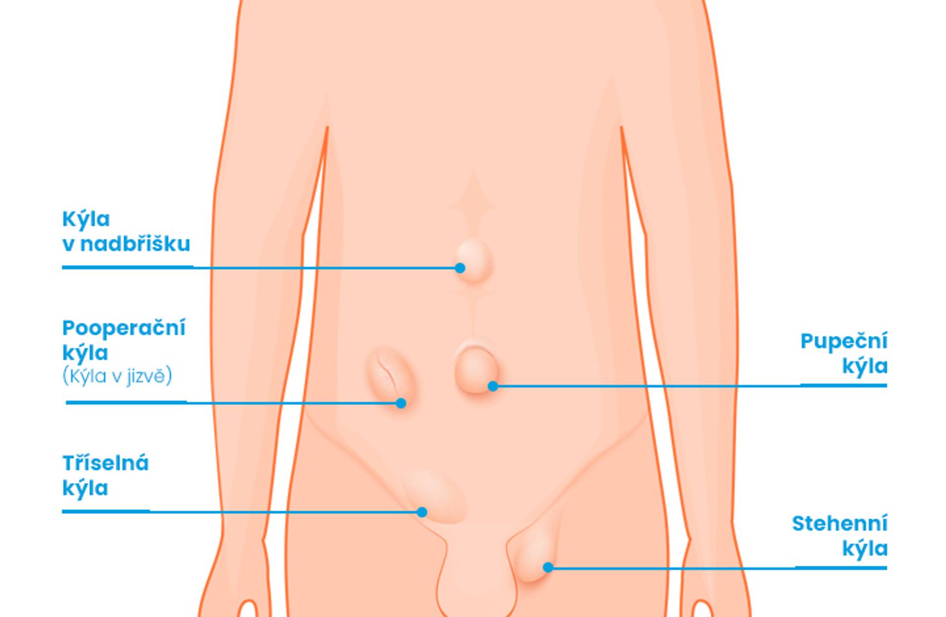 Infografika ISCARE - typy kýly