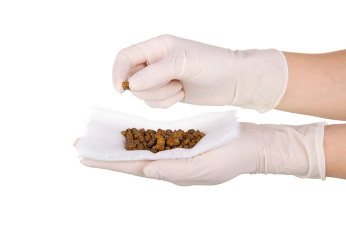 zlucnikoveé kameny, onemocneni zlucniku, klinika iscare