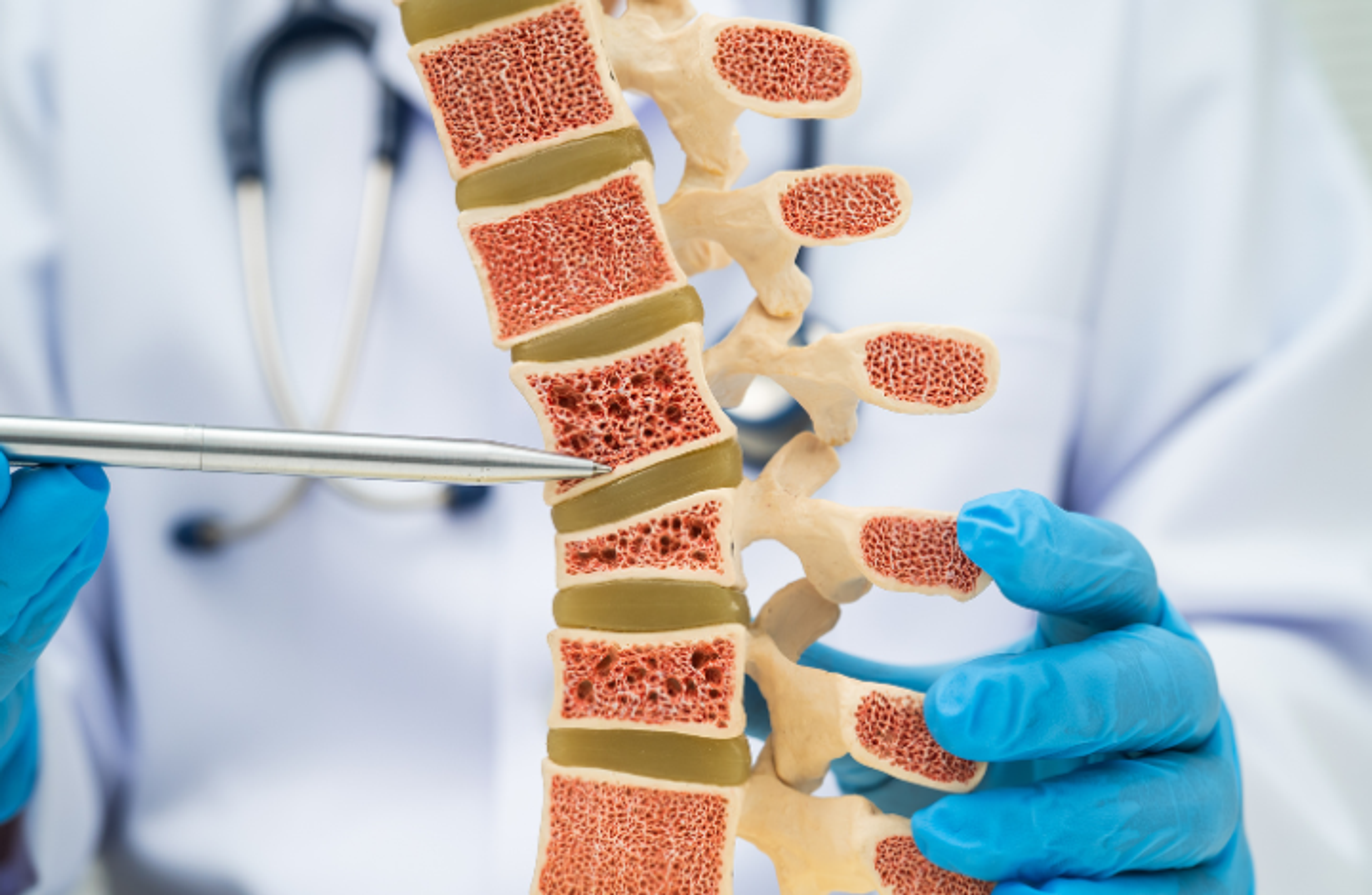 Co je to osteoporóza?